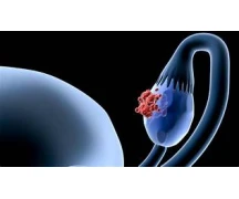 Test Onco ovario Test Onco ovario