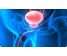 Test Prostata Pgx Oncologia de prostata Test Prostata Pgx Oncologia de prostata